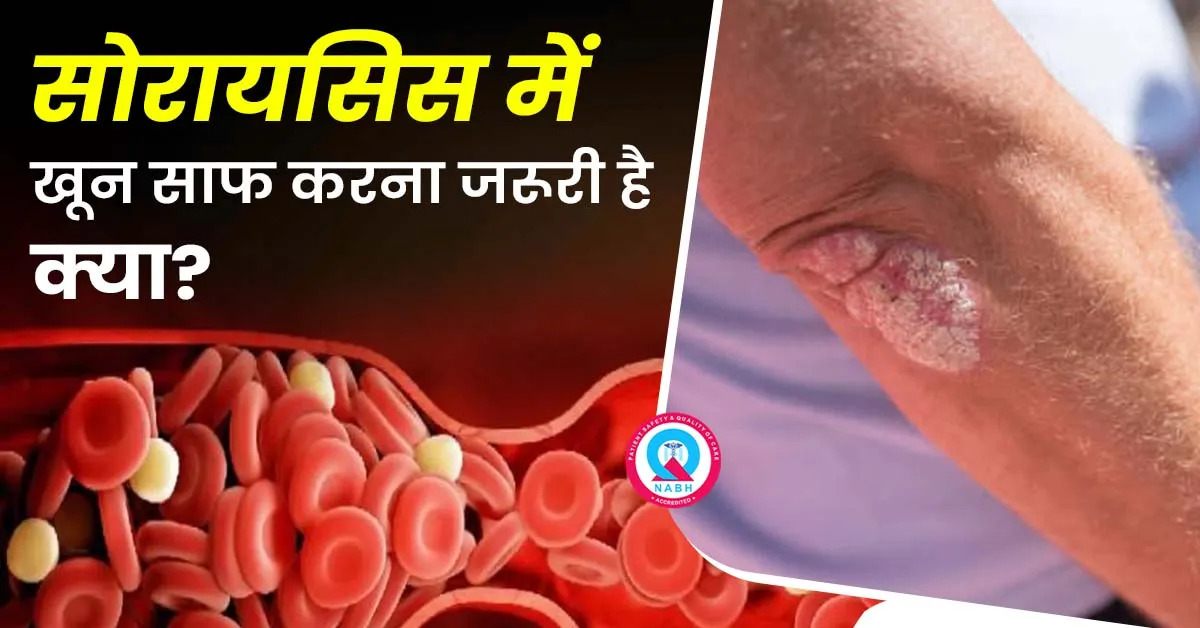 सोरायसिस-में-खून-साफ-करना-जरूरी-है-क्या